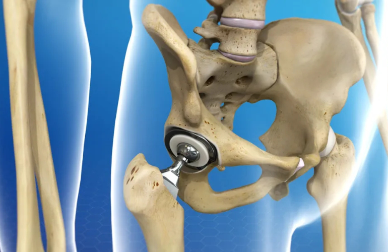 Hip Replacement